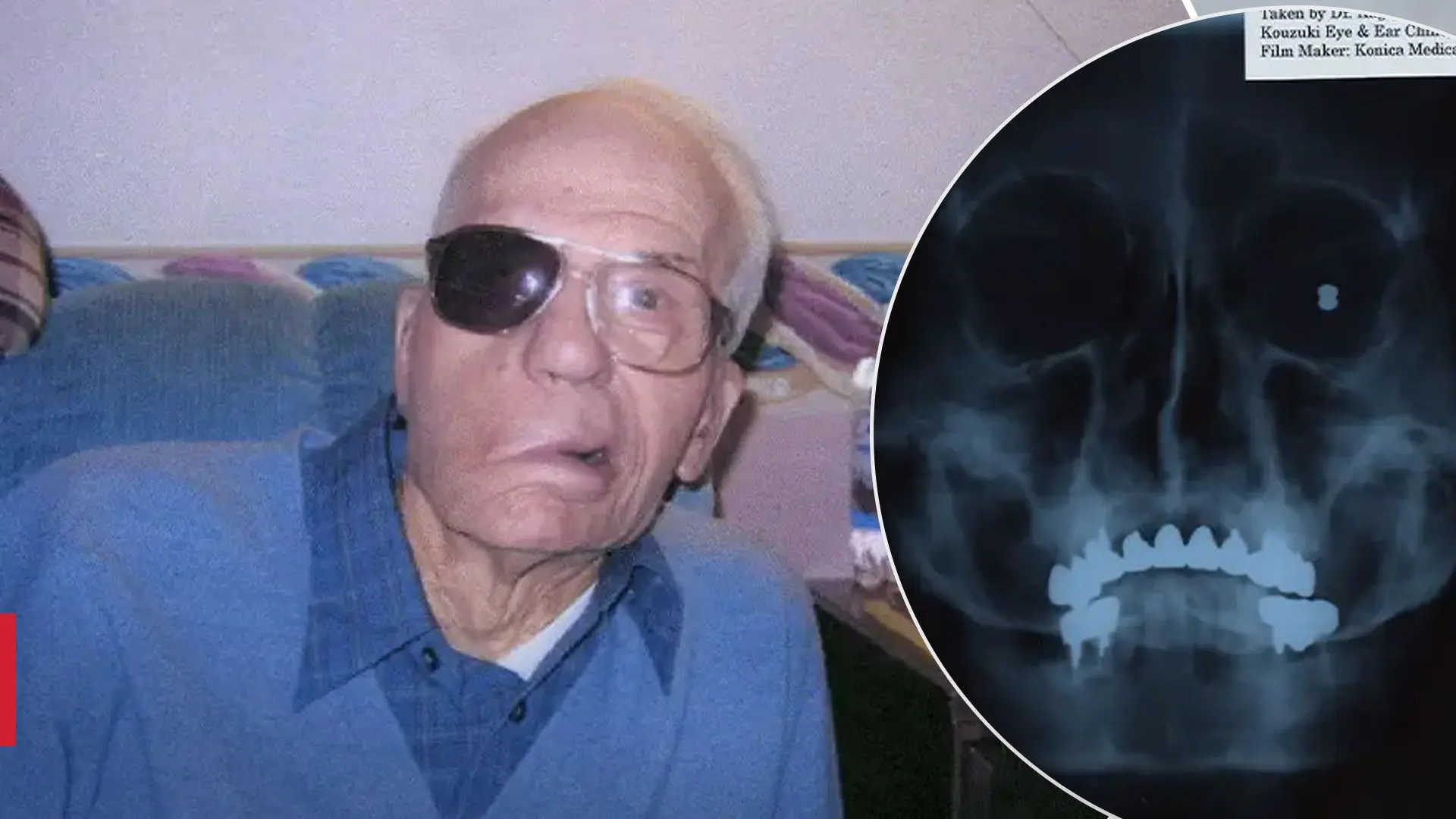 Як саме чоловік зміг прожити 94 роки з кулею в голові?