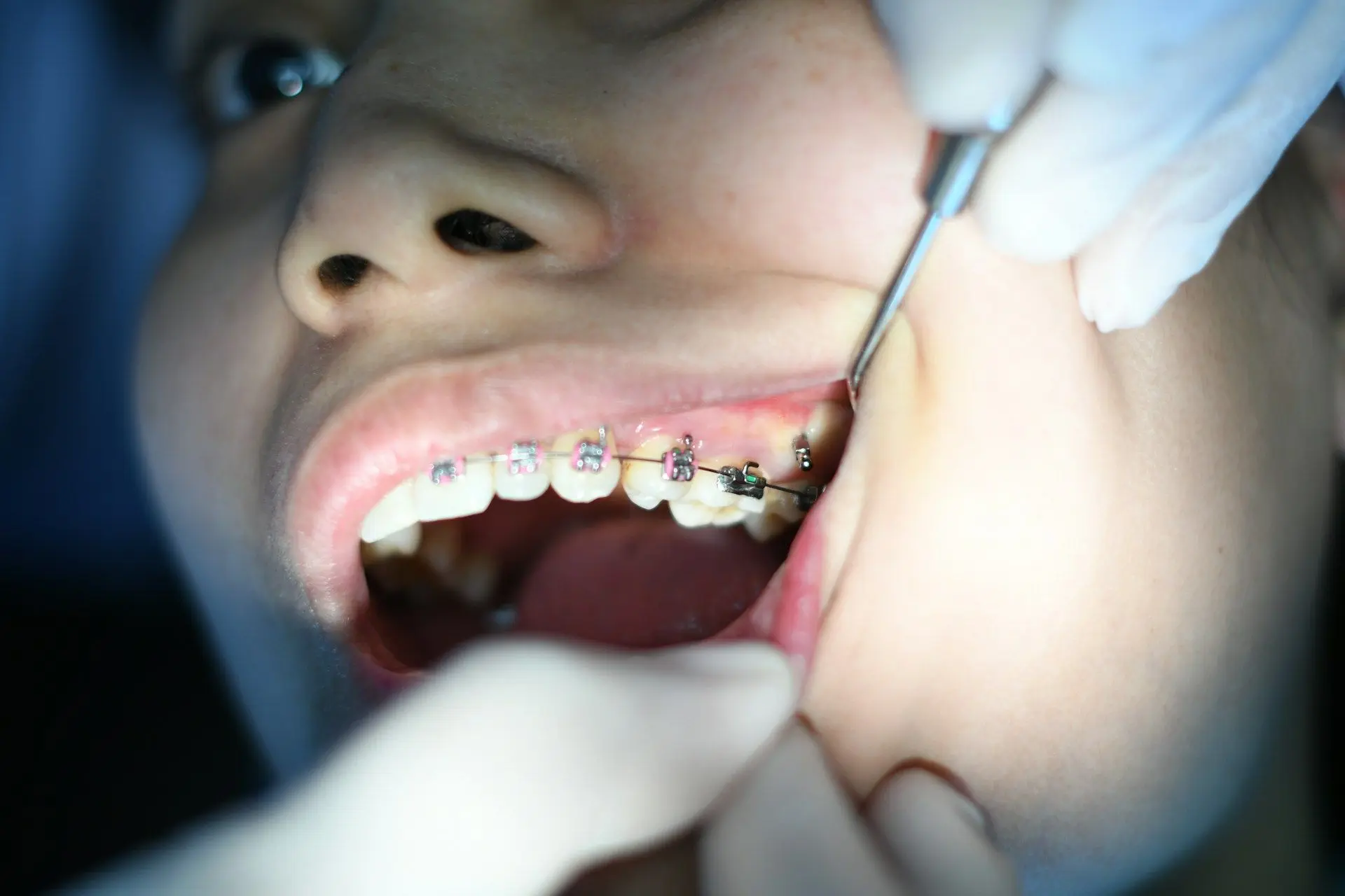 Чому зуби виростають не рівними та як уникнути цього